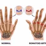 Romatoid Artrit Nedir?