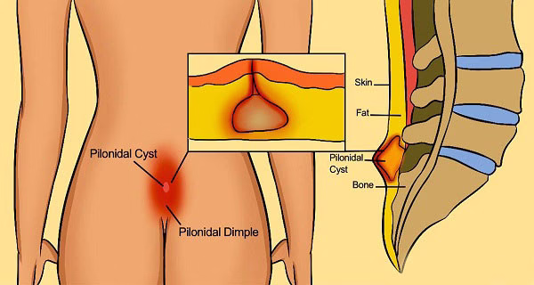kil-donmesi-tedavi-yöntemleri