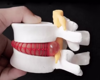 Fıtık Patlaması Nedir?